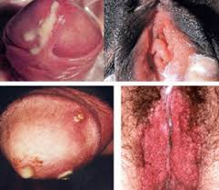 Illustration for article titled Obat Penyakit Sipilis Alami